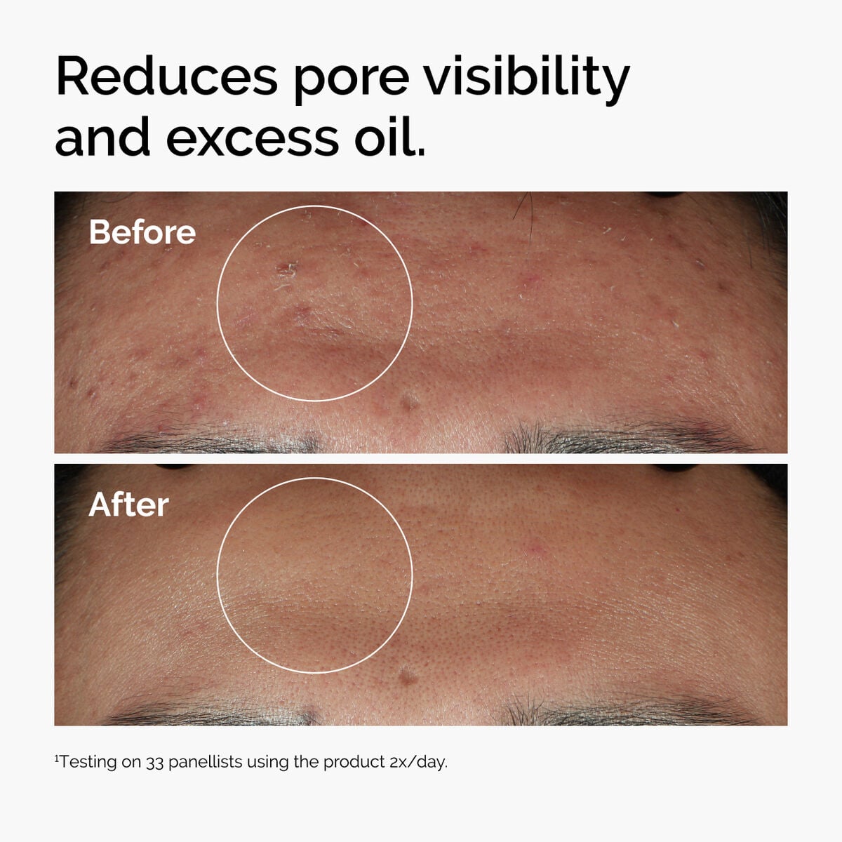 niacinamide-10-zinc-1-i9 ord-niacinamide-zinc-blemish-serum-before-after-pores.jpg
