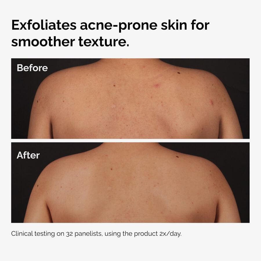 the-body-care-collection-c8 ord-salicylic-acid-body-serum-before-after-graphic-NA.jpg