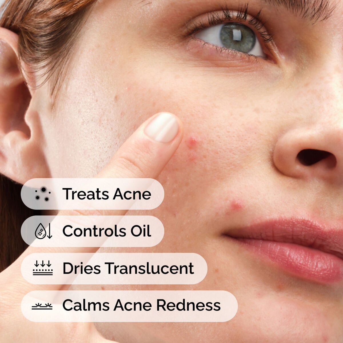 sulfur-10-powder-to-cream-concentrate-w2 ord-sulfur-10pct-powder-to-cream-concentrate-model-application-with-benefits-acne.jpg