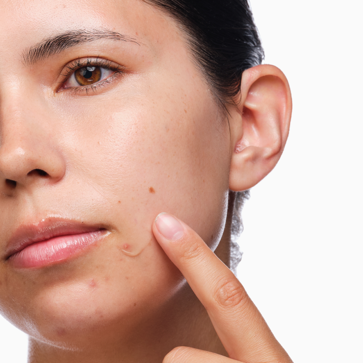 the-acne-set-s1 rdn-the-acne-set-application.png